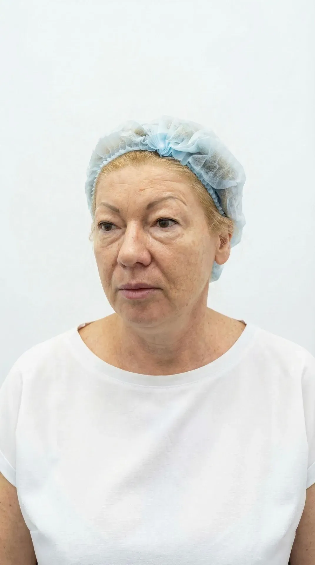 SMAS, шея, блефаропластика — до