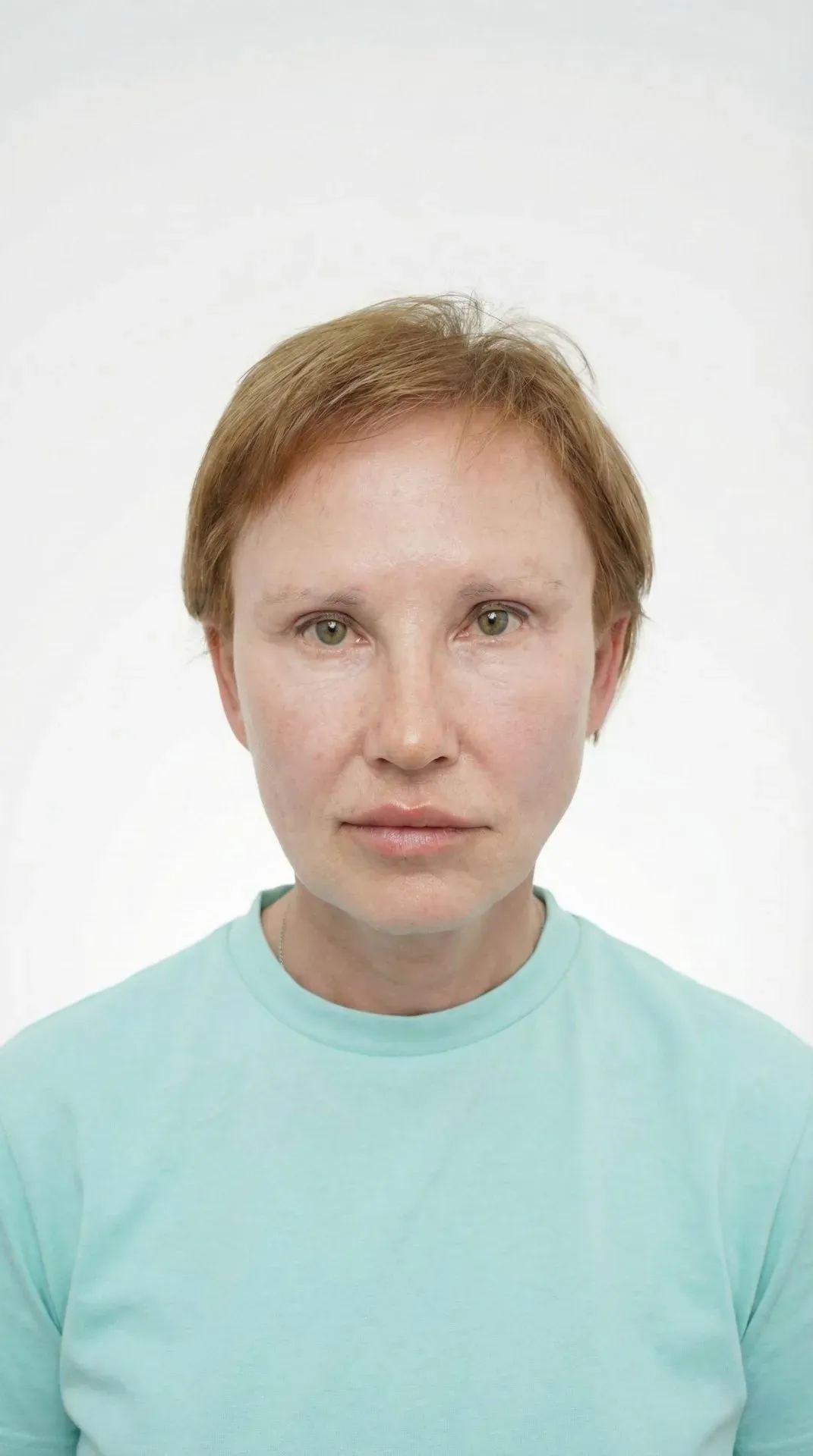 Фейслифт, шея, блефаро — после